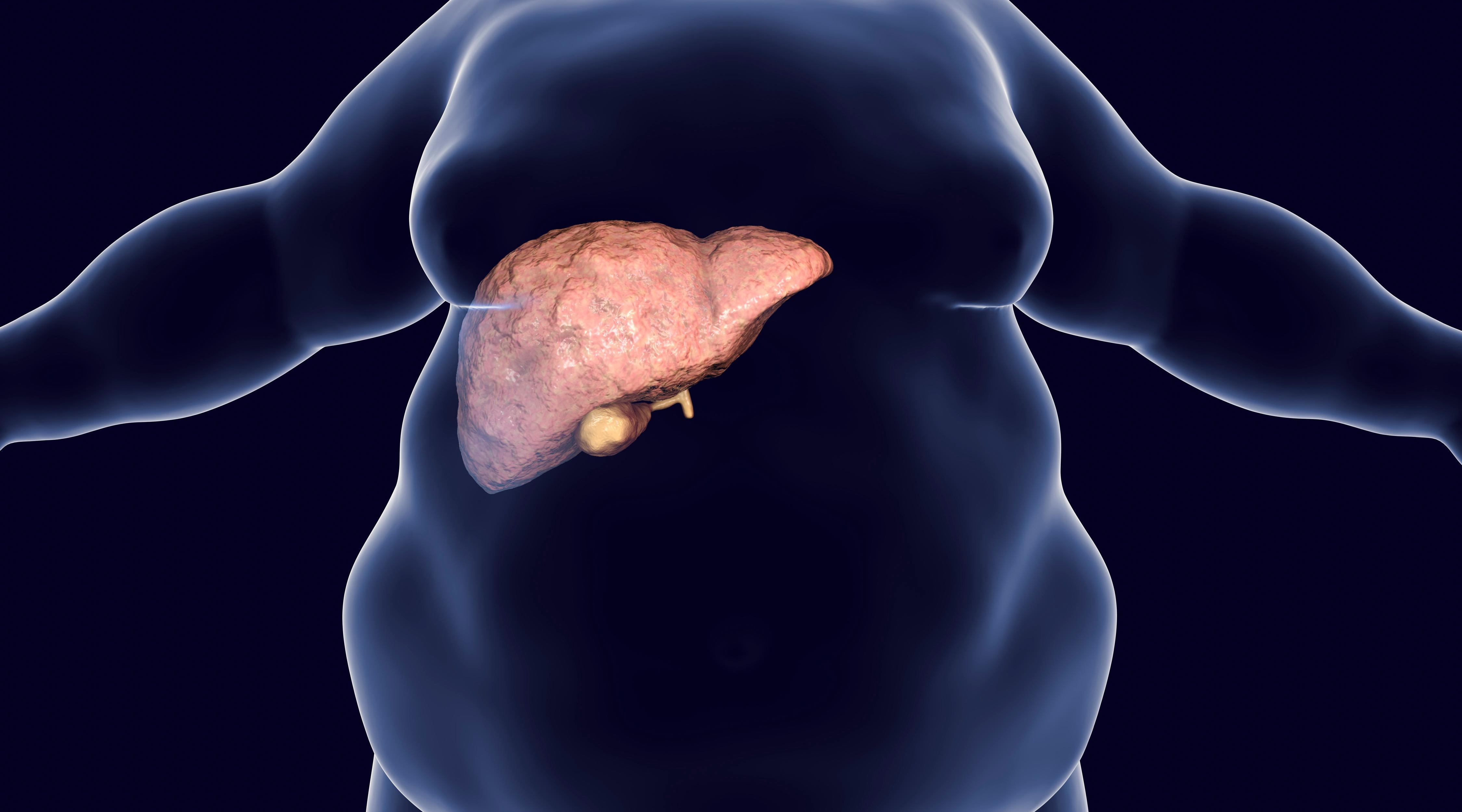 Fatty Liver Disease: A Comprehensive Exploration