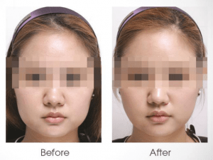 Facial Fat Lipolysis – Does it Work in Reducing Facial Fat?